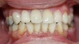 After done by Victorian Dental