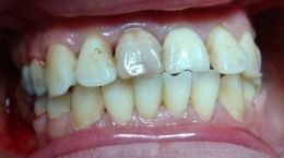 Before done by Victorian Dental
