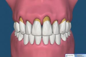 Healthy gum lacking gingivitis maintained by Victorian Dental