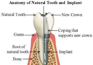 Dental Implants model against natural teeth done by Victorian Dental