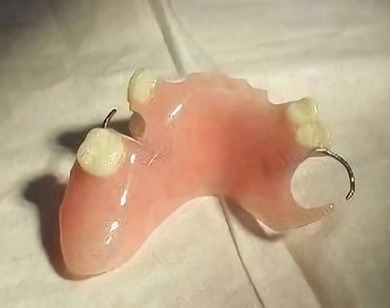 Acrylic partial denture done by Victorian Dental