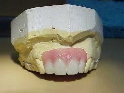 Metal based partial denture done by Victorian Dental