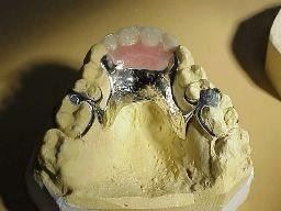 Metal based partial denture done by Victorian Dental
